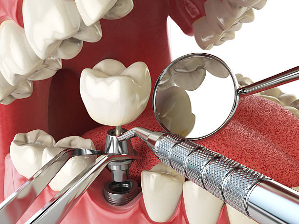Best Emergency Wisdom Teeth Removal in Arbury Hls, IL